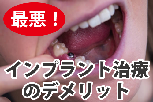 インプラント 歯医者